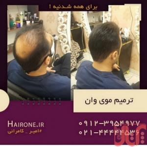 نصب پروتز مو به روش بریدینگ